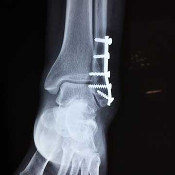 Fracture opérée